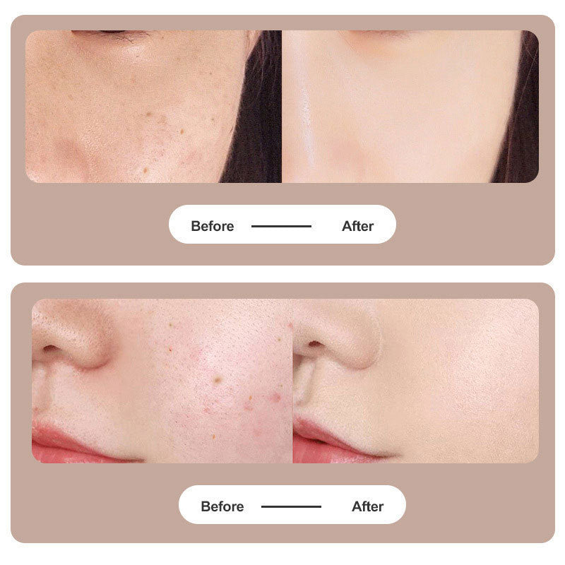 Plasma Pen for tattoo and mole removal | Skanto