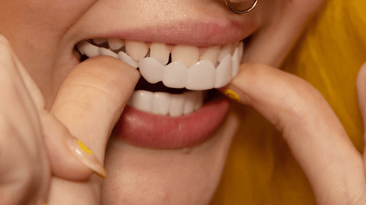 Skanto | Umiddelbar Smile Transformasjon med Snap on Smile Filler