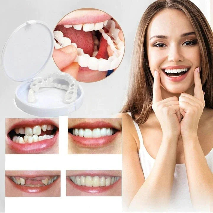 Sofortige Verschönerung Ihres Lächelns med Snap-on-Veneers