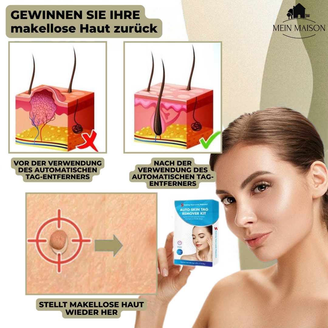 Skanto | DermaLinx Vortefjerner | Smertfri fjerning av vorter og føflekker | For hjemme | Uten kirurgi