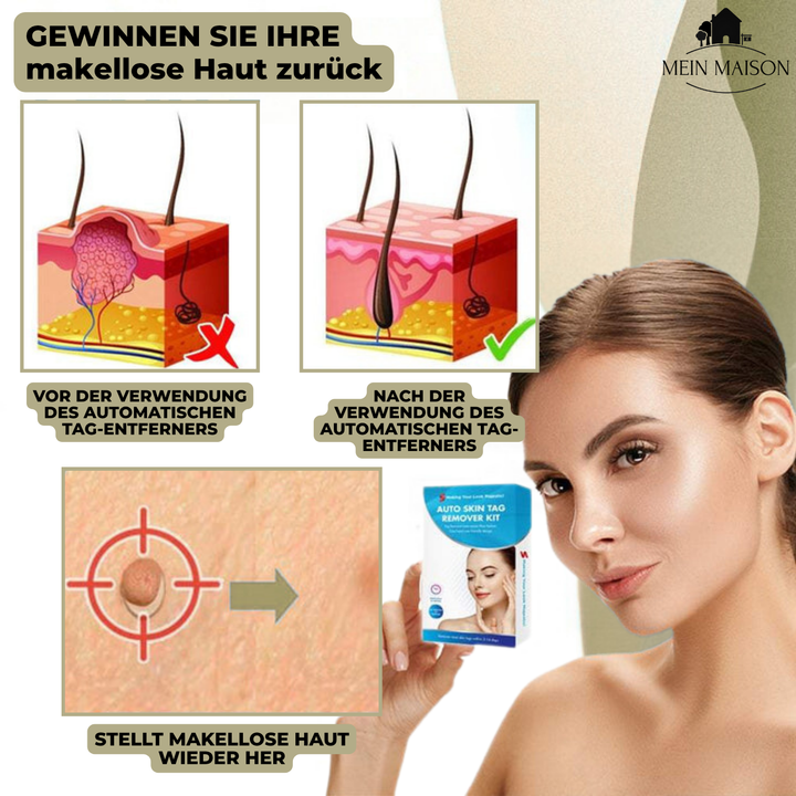 Skanto | DermaLinx Vortefjerner | Smertfri fjerning av vorter og føflekker | For hjemme | Uten kirurgi