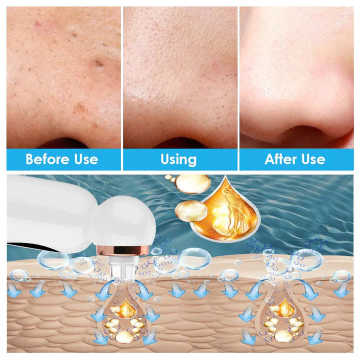 Skanto | Blackhead Remover og Hydrodermabrasjonsenhet