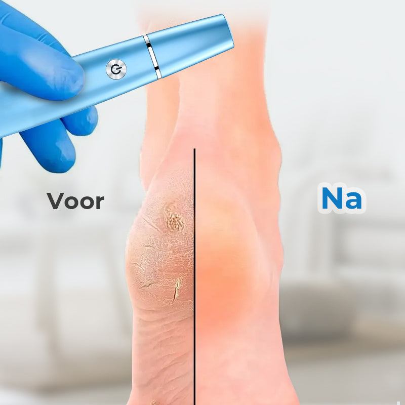 Skanto | SmoothFoot – Oppnå silkeslitt føtter på bare noen få minutter