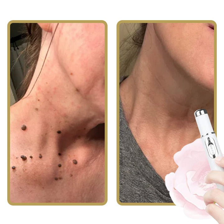 Skanto | ClearDerm - Rask, smertefri kvisefjerning for glatt, klar hud