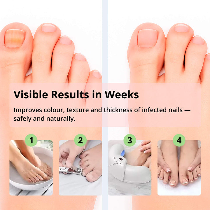 Laser Nail Treatment Device – Rød og blå lys mot neglesopp | Skanto