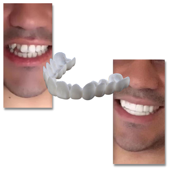 Perfekt smil tanndekning - komfortable finér