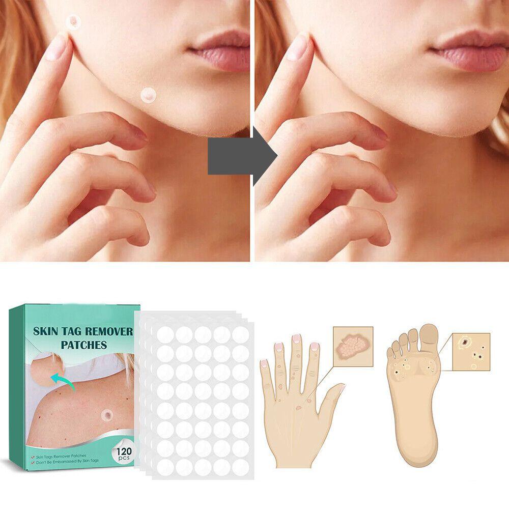 SkinClear - Patches for fjerning av flekker og vorter Skanto