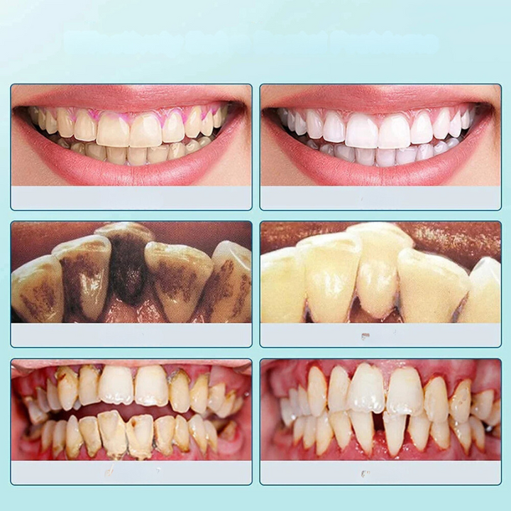 Skanto | SmilePro Ultrasonisk Tannsteinfjerner – Effektiv Plakkfjerner for Hjemmet