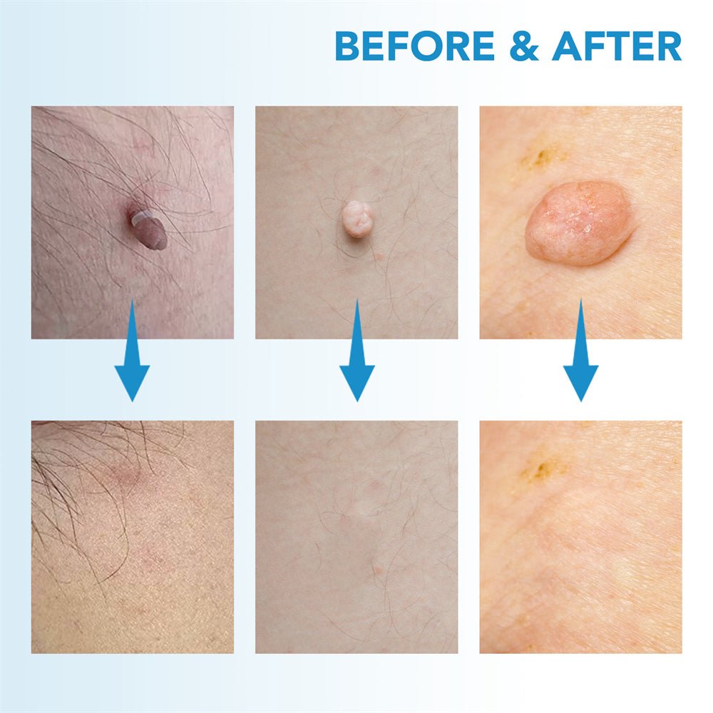 Skanto | EPICLEAR – Hjemme Skin Tag & Vortefjerner Kit