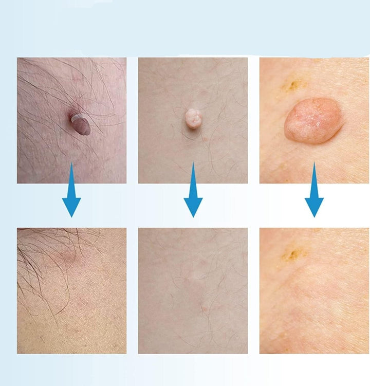 Skanto | EPICLEAR – Hjemme Skin Tag & Vortefjerner Kit