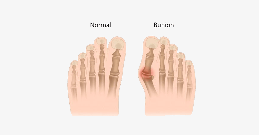 Skanto | Komfort Helbredende Tåseparatorer og Hallux Valgus Avstandholdere