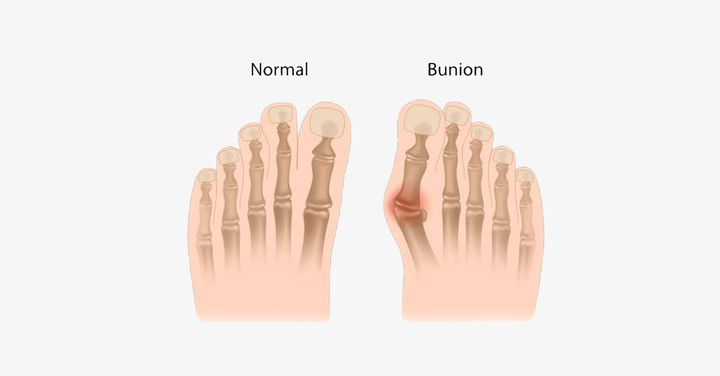 Skanto | Komfort Helbredende Tåseparatorer og Hallux Valgus Avstandholdere