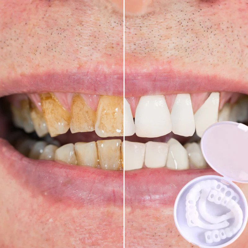 Skanto | SmileSnap - Alltid det perfekte smilet med disse skjærene