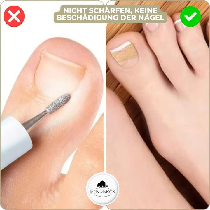 ALIGNSTRIP – Schmerzfreie Nagelkorrekturstreifen for eingewachsene und deformierte Nägel