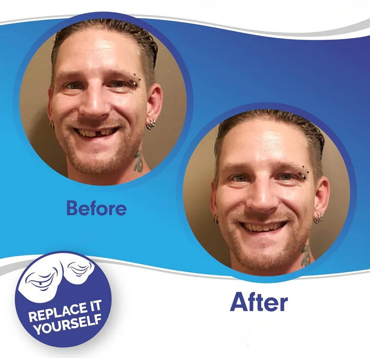 Skanto | Avtagbare Smile Veneers for Øvre og Nedre Tenner