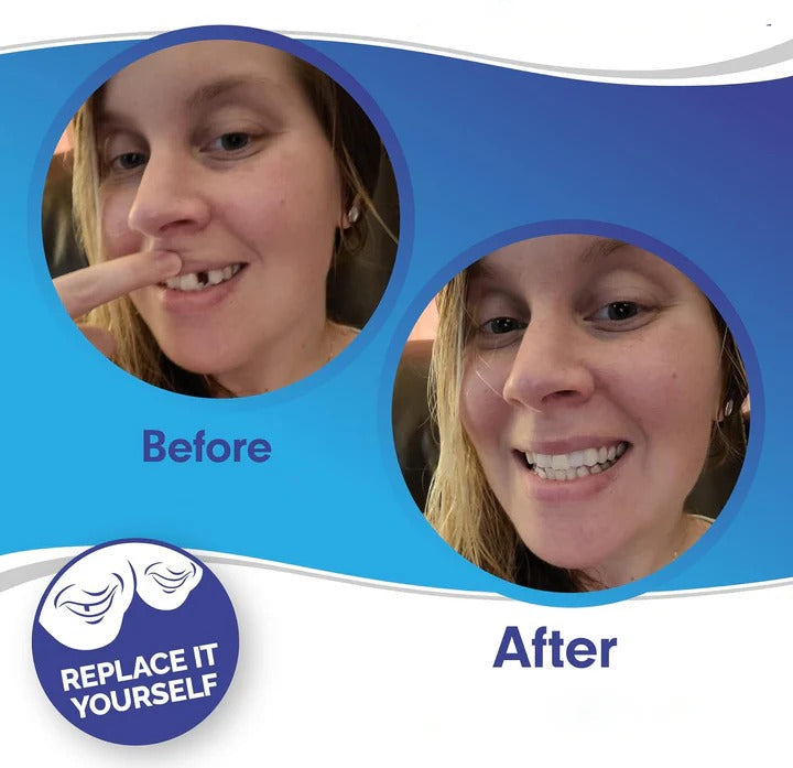 Skanto | Avtagbare Smile Veneers for Øvre og Nedre Tenner