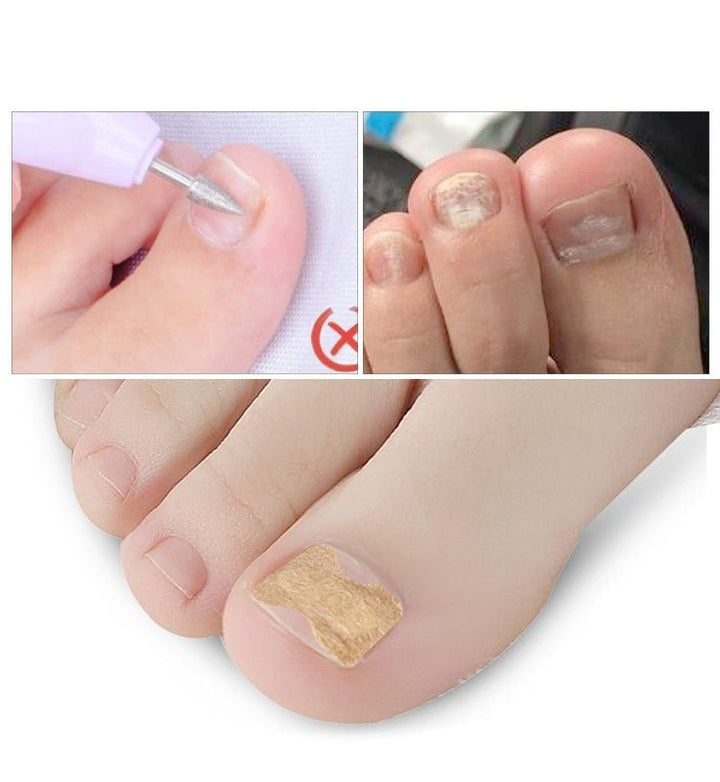 Skanto | Painless Toenail Patch - ToenailExpress