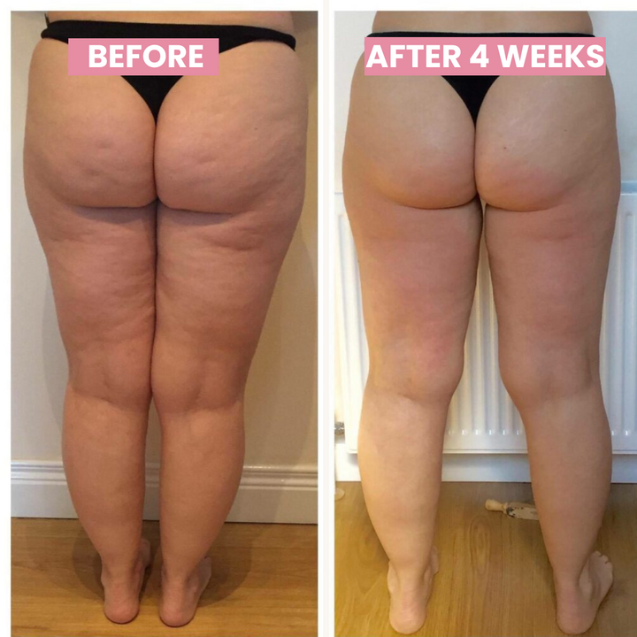Skanto | SlimCupp Anticellulite Cupping Enhet